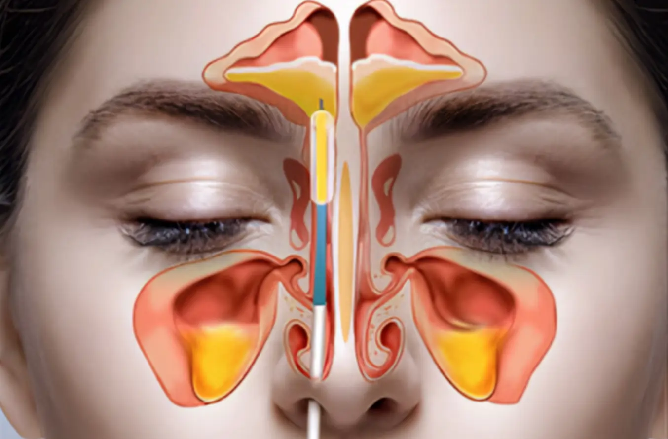 Cirugía nasal