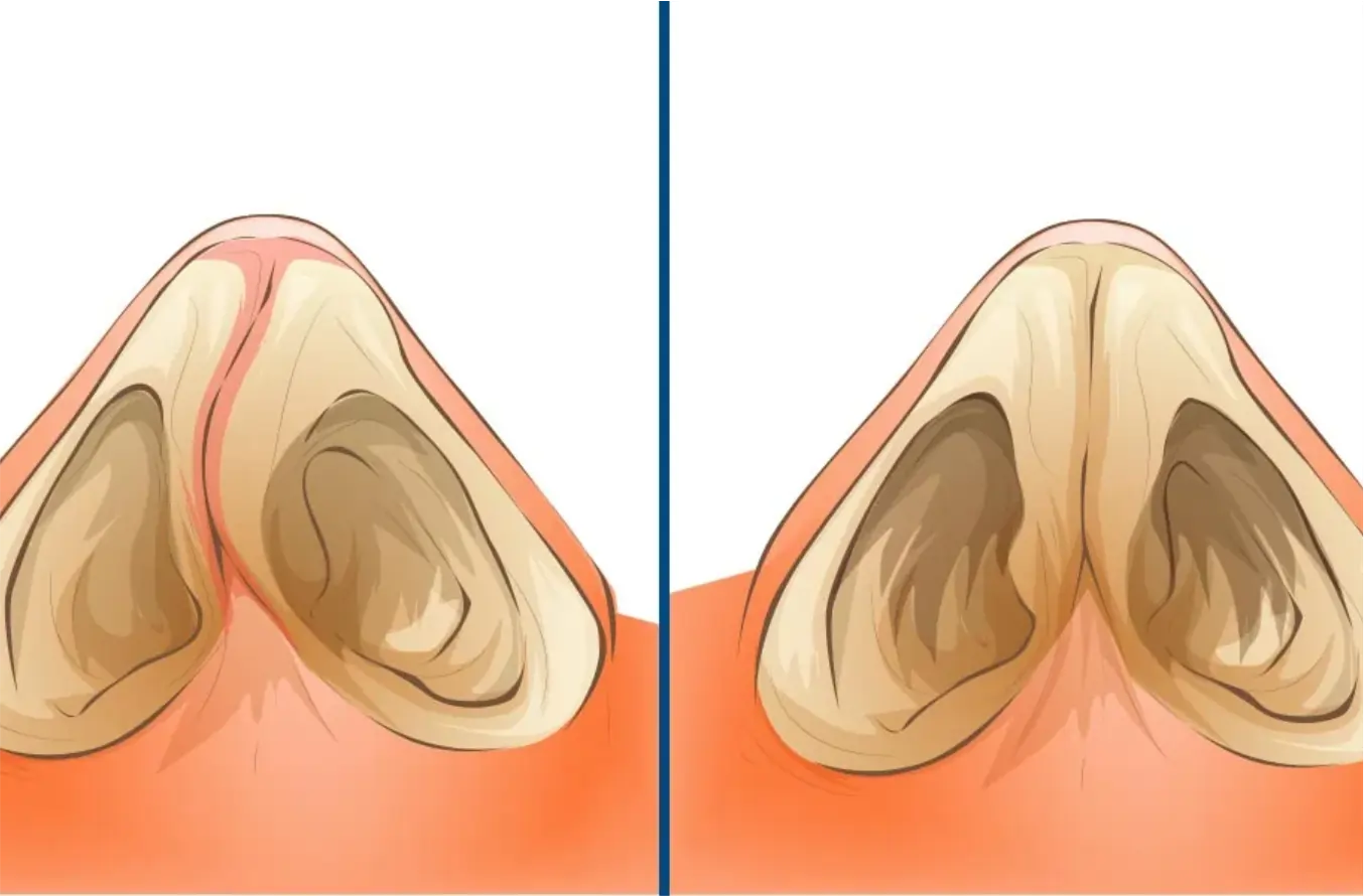 Septoplastia