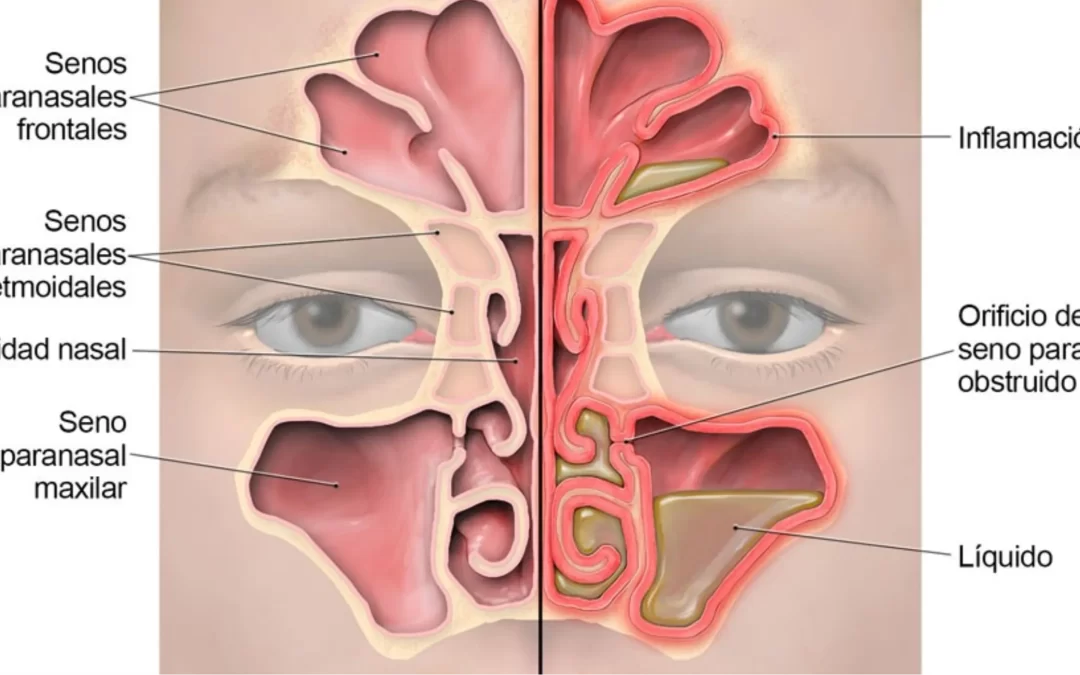 Cirugía endoscópica nasal: qué es, cuándo se necesita y cómo es la recuperación