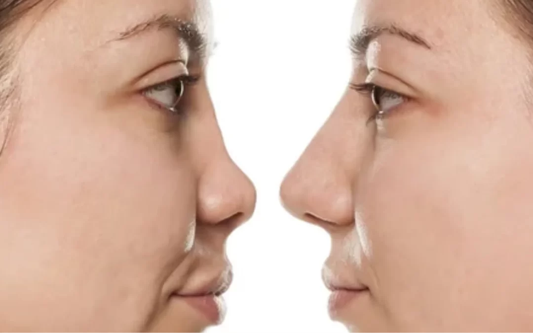 Rinoplastia funcional: mejorar la respiración y la estética de la nariz