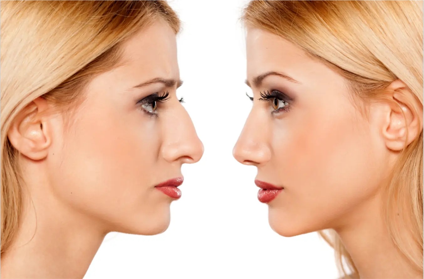 Rinoplastia